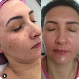 Curso Zena Peeling de Algas é Bom